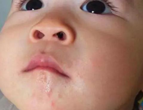 宝宝得了口水疹,口水疹可以抹口水疹膏吗