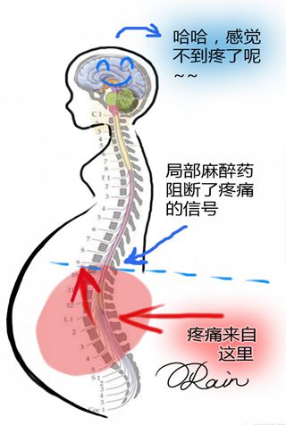 孕妇产房分娩阵痛,分娩镇痛椎管内麻醉