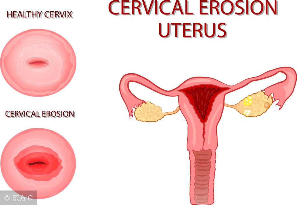 宫颈糜烂这些症状你有吗？为何会找上你？