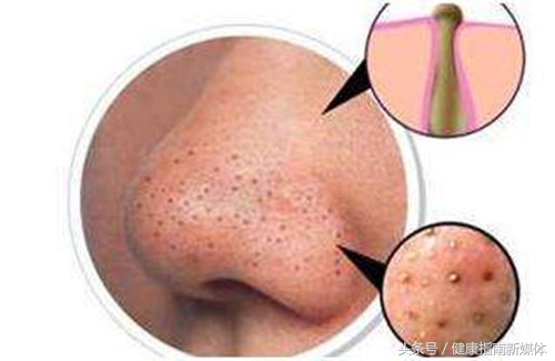 15岁男孩挤青春痘感染,挤痘感染致死案例