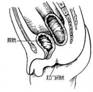 刚生下的男婴没肛怎么办,出生的孩子无肛直肠瘘