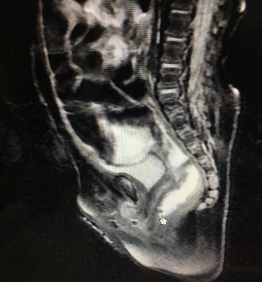 刚生下的男婴没肛怎么办,出生的孩子无肛直肠瘘