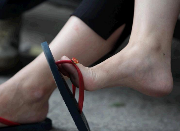 脚跟干裂怎么办用什么泡脚,脚跟脱皮干裂用醋泡脚有用吗