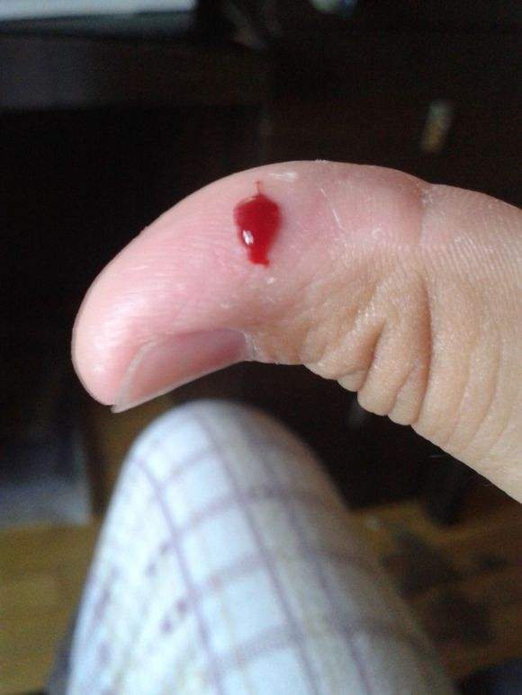 如果心脏被利器刺穿血从哪流出来,碎玻璃扎进肉里会进入血管吗