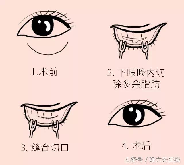 眼袋泪沟怎么去除男生,眼袋和泪沟怎么去除要多少钱