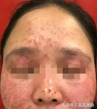 祛斑最有效方法辟谣,十大坑人的网红祛斑产品