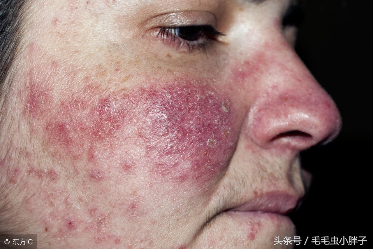 痘痘肌的处理及应对方法,痘痘大作战有没有秘籍