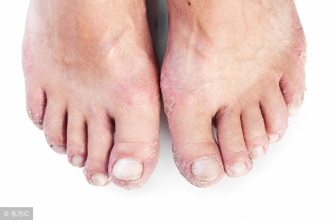 麻疹会难受吗,麻疹会伴随着发热吗