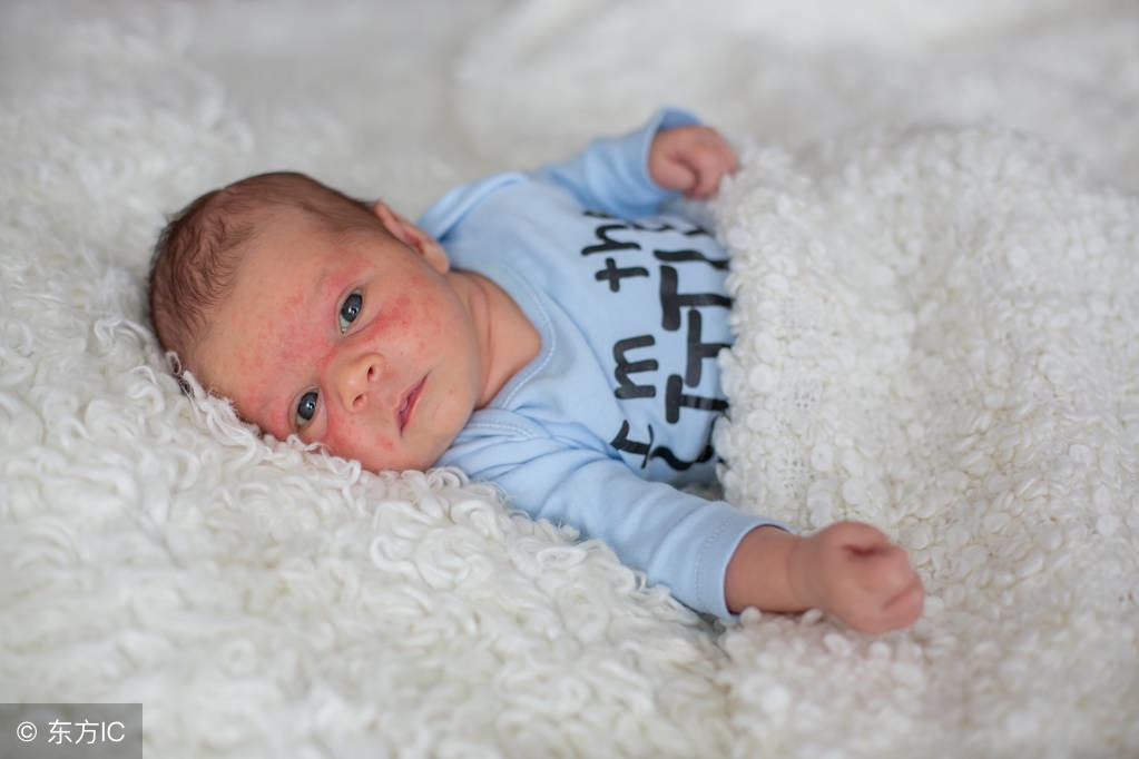 红屁股口水疹湿疹,湿疹口水疹的预防