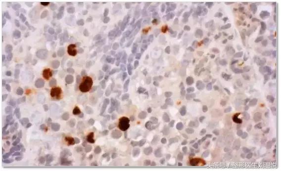 孕期吃布洛芬有影响吗,布洛芬对怀孕早期的影响