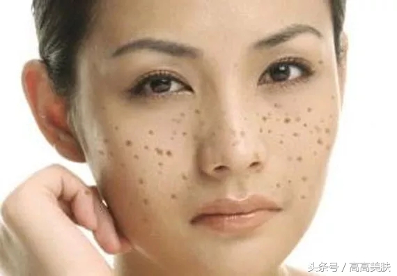 祛斑最有效方法辟谣,十大坑人的网红祛斑产品