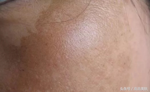 祛斑最有效方法辟谣,十大坑人的网红祛斑产品