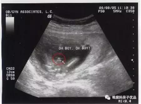 怀孕多久可以做B超，做几次比较适合？