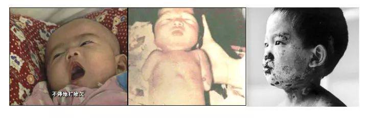 死胎、畸形、*品毒**宝宝，吸毒后怀孕，宝宝会有哪些症状