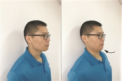 青少年驼背怎么办？这些动作应该练