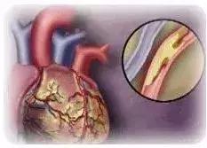 高血脂患者易忽视的七大误区,高血脂症的误区有几点