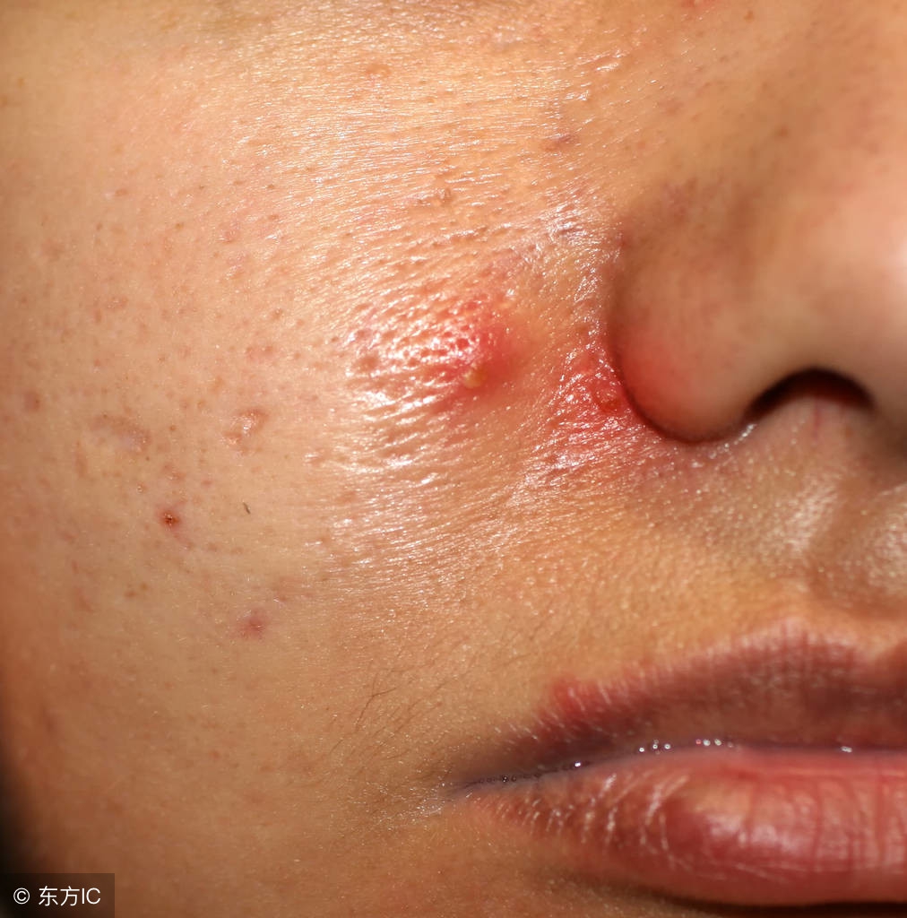 疱疹有什么治疗方法,疮肿的最佳治疗方法