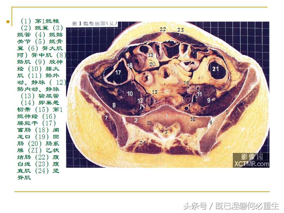 男性盆腔断层解剖图谱,女性盆腔核磁断层解剖