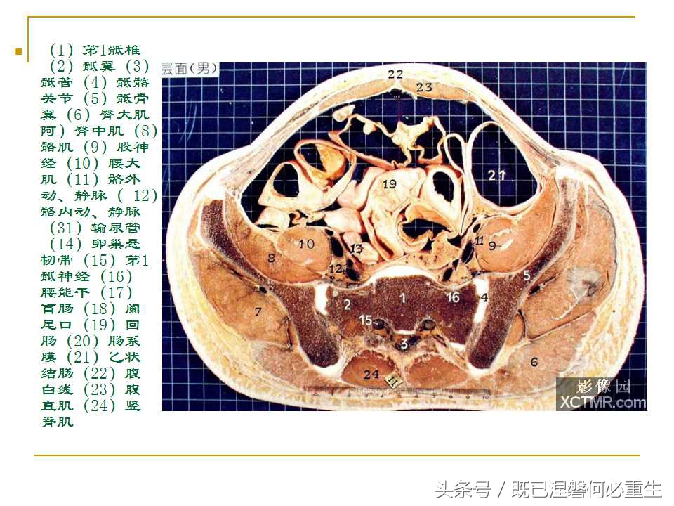 男性盆腔断层解剖图谱,女性盆腔核磁断层解剖