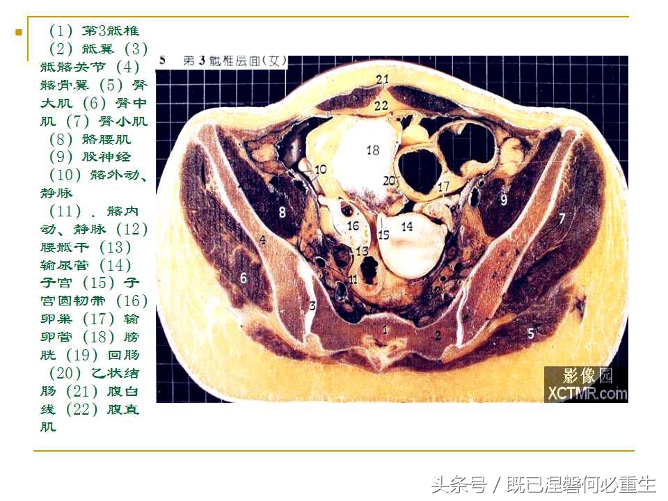 男性盆腔断层解剖图谱,女性盆腔核磁断层解剖