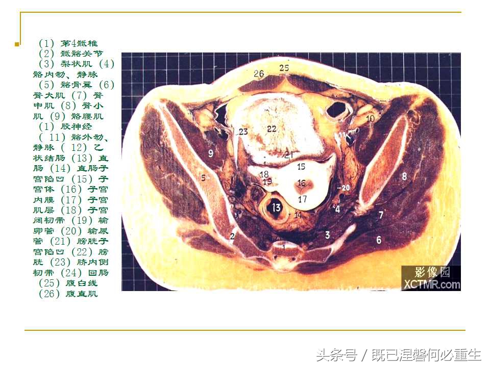 男性盆腔断层解剖图谱,女性盆腔核磁断层解剖
