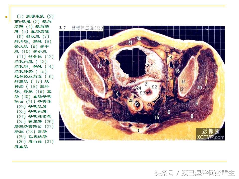 男性盆腔断层解剖图谱,女性盆腔核磁断层解剖
