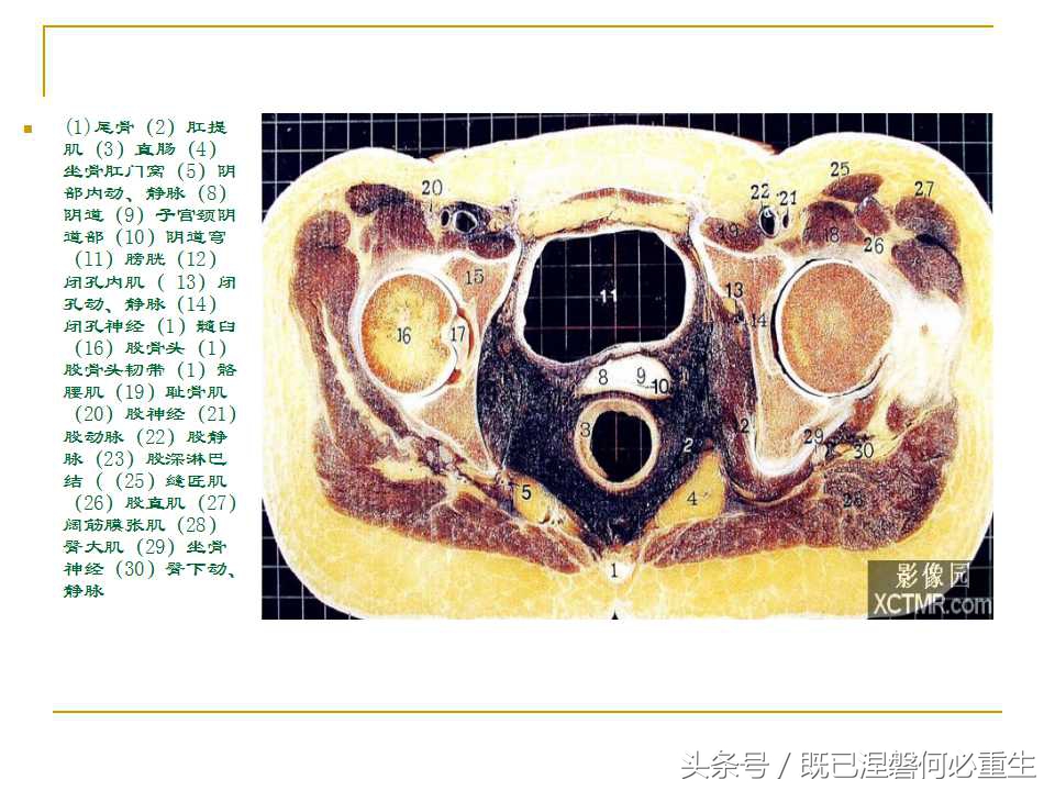 男性盆腔断层解剖图谱,女性盆腔核磁断层解剖