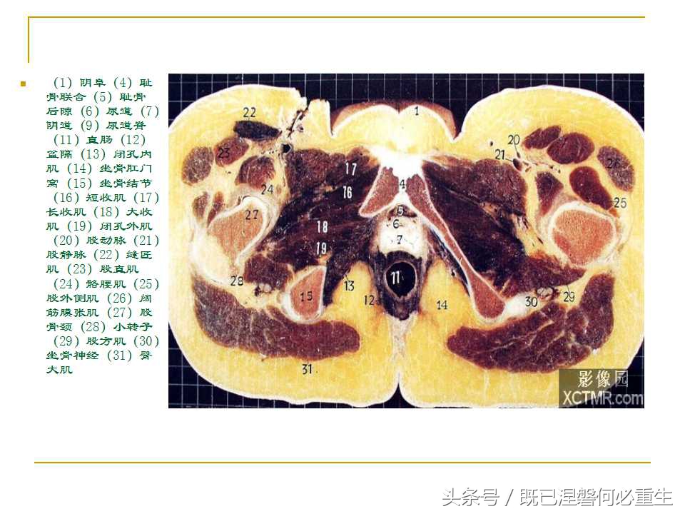 男性盆腔断层解剖图谱,女性盆腔核磁断层解剖
