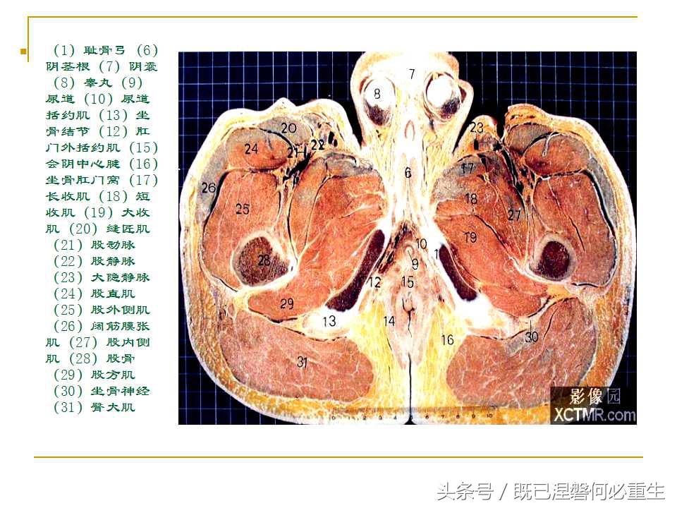 男性盆腔断层解剖图谱,女性盆腔核磁断层解剖