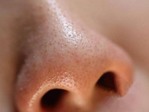 毛孔堵塞有黄色油脂,毛孔长黄色油脂粒