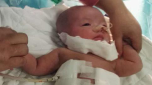 食道闭锁儿童医院,北京儿童医院新生儿食道闭锁