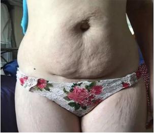 抹预防妊娠纹的精油手法,妊娠纹预防油推荐