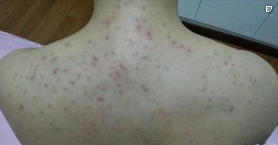 痘印变黑一直不消怎么办,痘印变黑后怎么消除