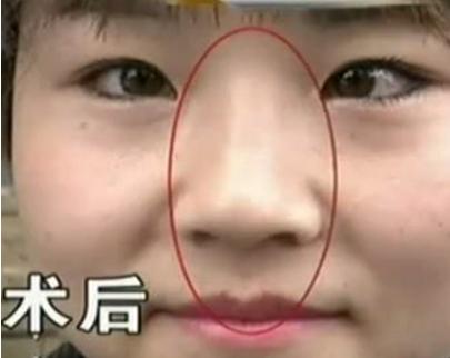 花了30万整的鼻子,花了10万整的鼻子