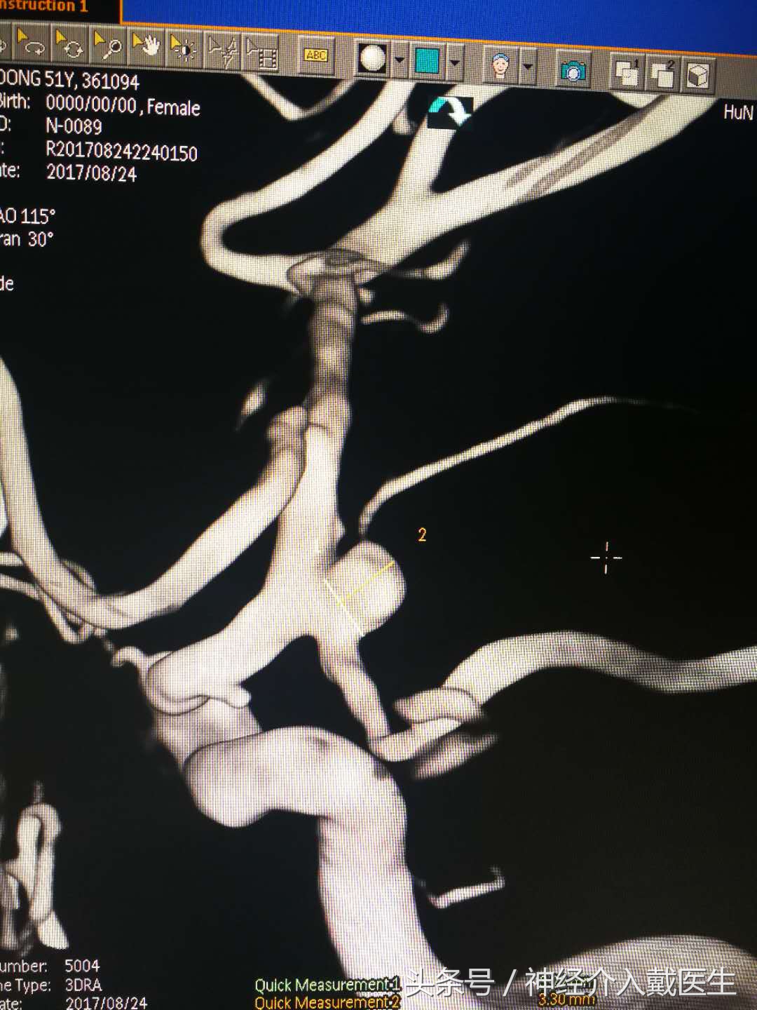 股动脉穿刺后假性动脉瘤处理,体检发现脑动脉瘤该怎么处理