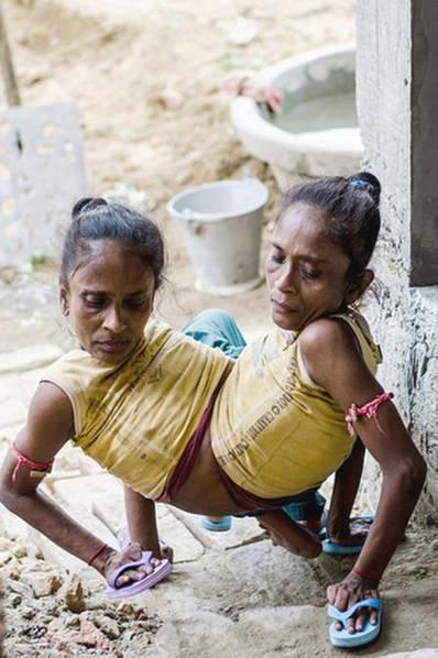 连体婴姐妹其中一个结婚了,连体姐妹一人结婚视频完整版