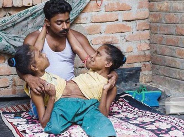 连体婴姐妹其中一个结婚了,连体姐妹一人结婚视频完整版