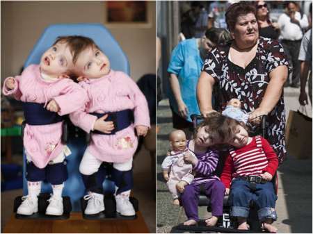 连体婴姐妹其中一个结婚了,连体姐妹一人结婚视频完整版