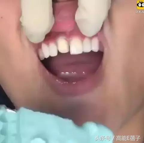 高圆圆牙齿美白,高圆圆40岁美白秘诀