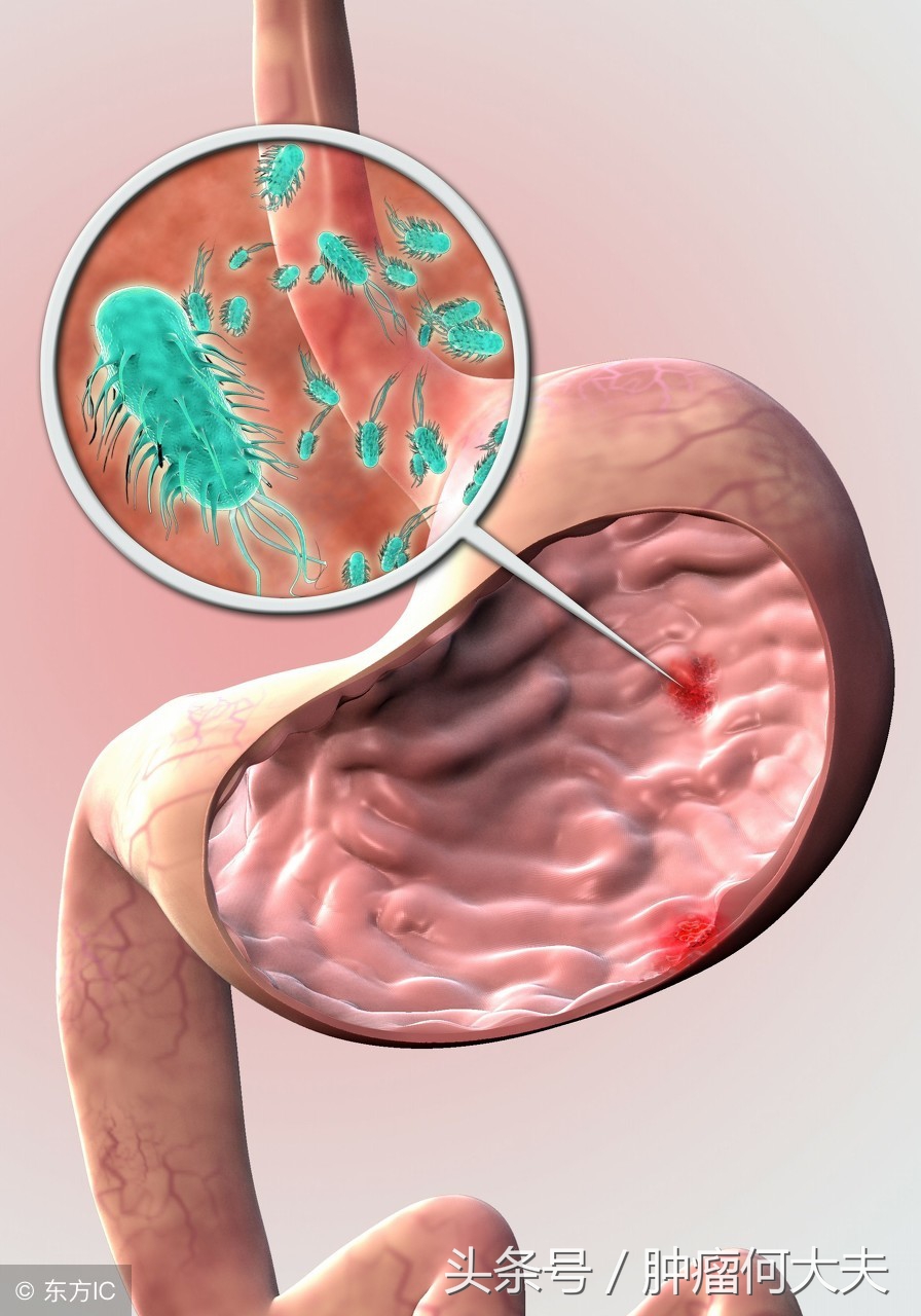 根除幽门螺杆菌是胃癌的一级预防,胃癌手术后还有幽门螺杆菌怎么办