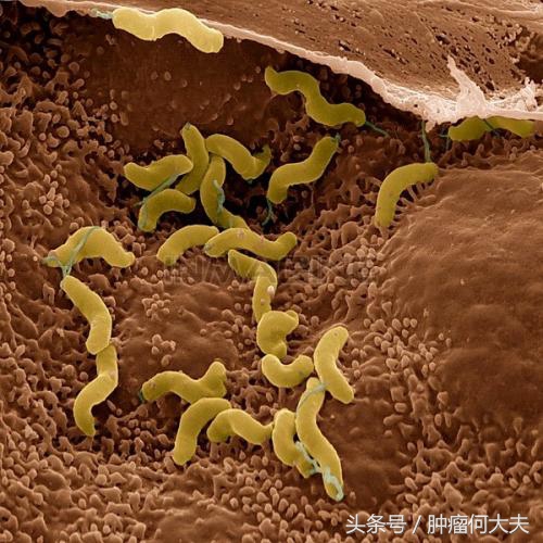 根除幽门螺杆菌是胃癌的一级预防,胃癌手术后还有幽门螺杆菌怎么办