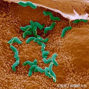 根除幽门螺杆菌是胃癌的一级预防,胃癌手术后还有幽门螺杆菌怎么办