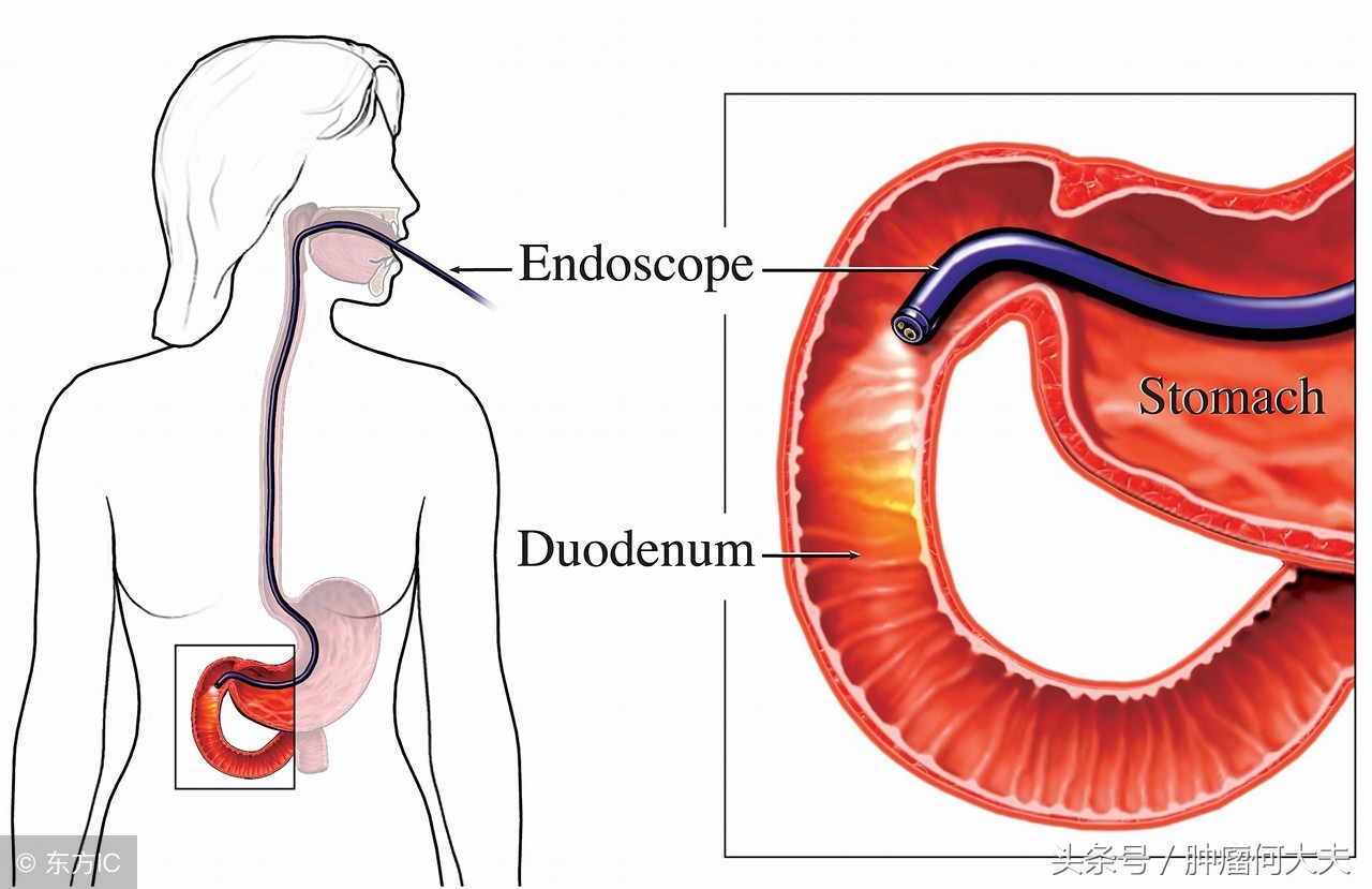 根除幽门螺杆菌是胃癌的一级预防,胃癌手术后还有幽门螺杆菌怎么办