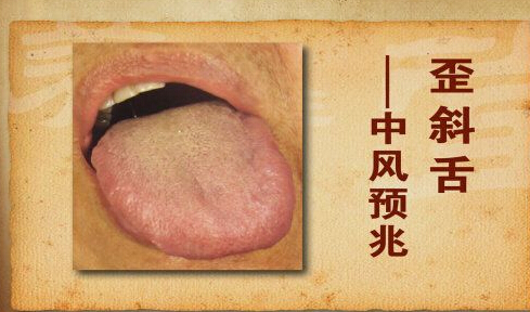 头晕带有手麻和舌头发麻,头晕发麻手发麻是什么病的前兆