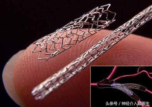 脑血管支架植入术适应症及禁忌症,脑血管介入取栓下支架后出血