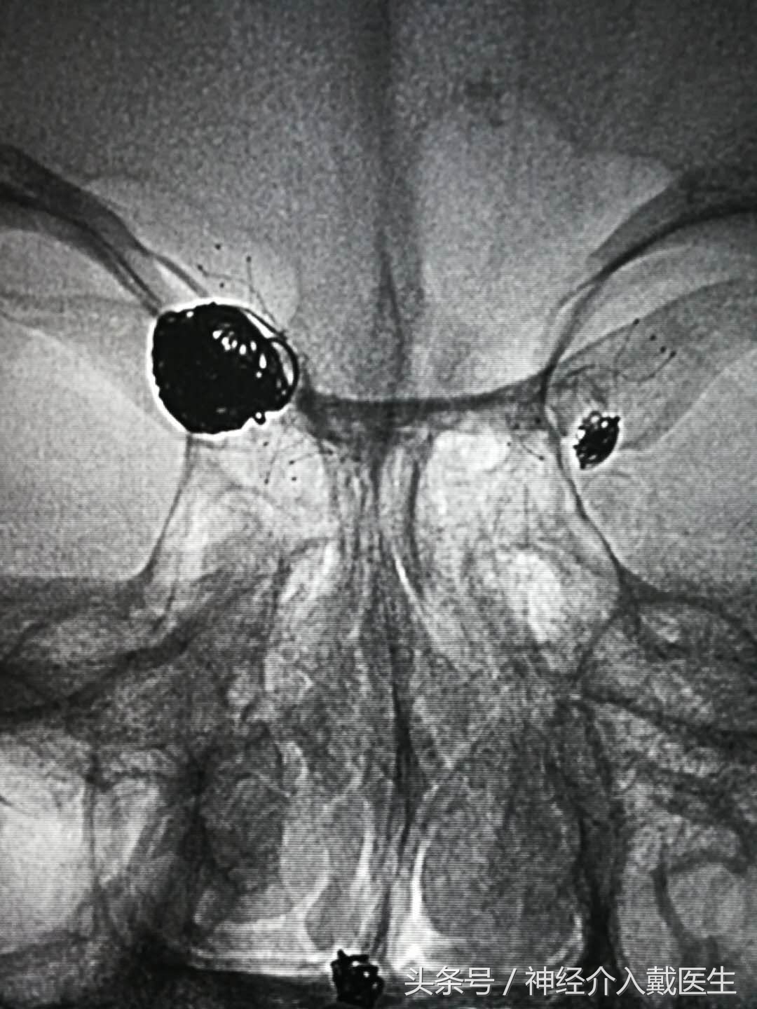 脑血管支架植入术适应症及禁忌症,脑血管介入取栓下支架后出血
