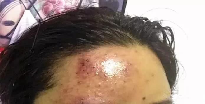 姐妹互打玻尿酸差点毁容,网购玻尿酸注射结果内幕大曝光