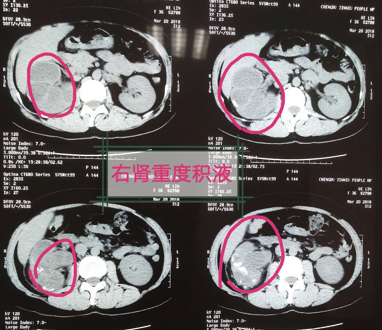 巨大型肾结石,超大肾结石最快的排出方法