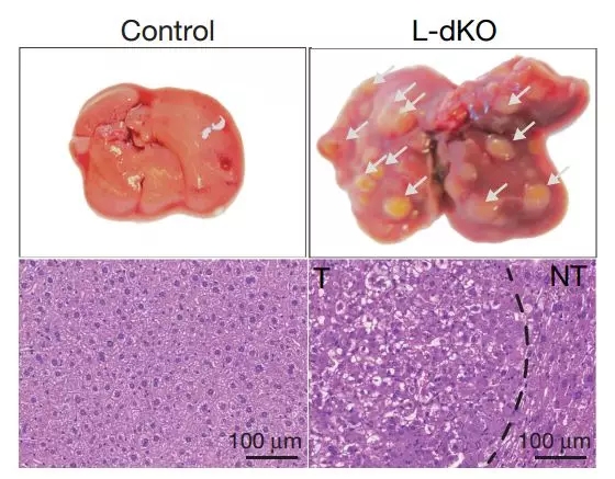 肝癌大突破!拉斯克奖大牛发现全新抑癌蛋白