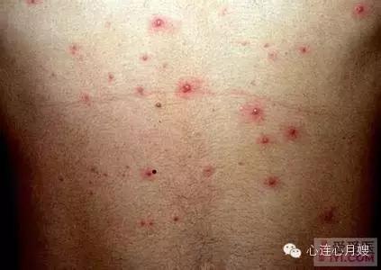 急疹湿疹如何快速治好,麻疹风疹水痘幼儿急疹的区别